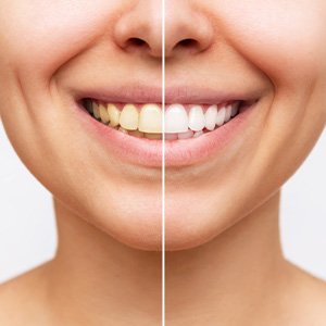 Woman’s smile before and after teeth whitening