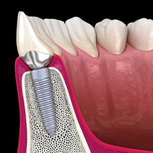 Side-view of dental implant in jawbone