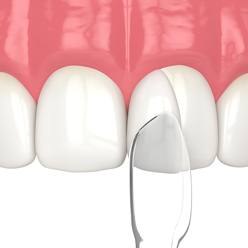 Illustration of dental bonding being placed on tooth