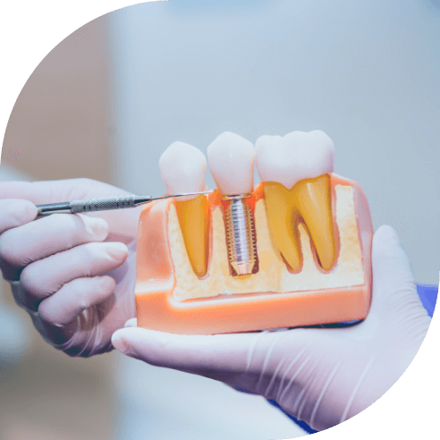Model comparing dental implant supported dental crown to natural teeth