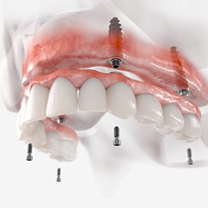 Illustration of implant dentures for upper dental arch