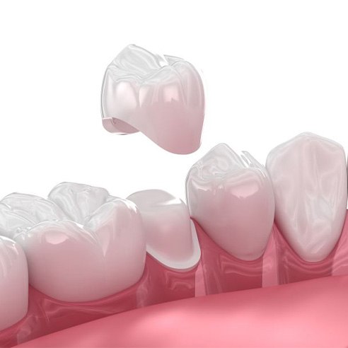 Illustration of porcelain crown being placed on tooth